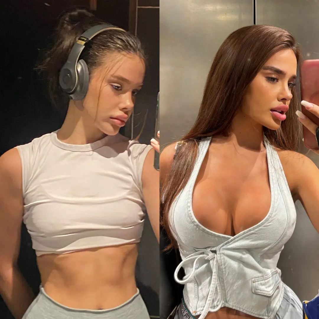 BREAST AUGMENTATION