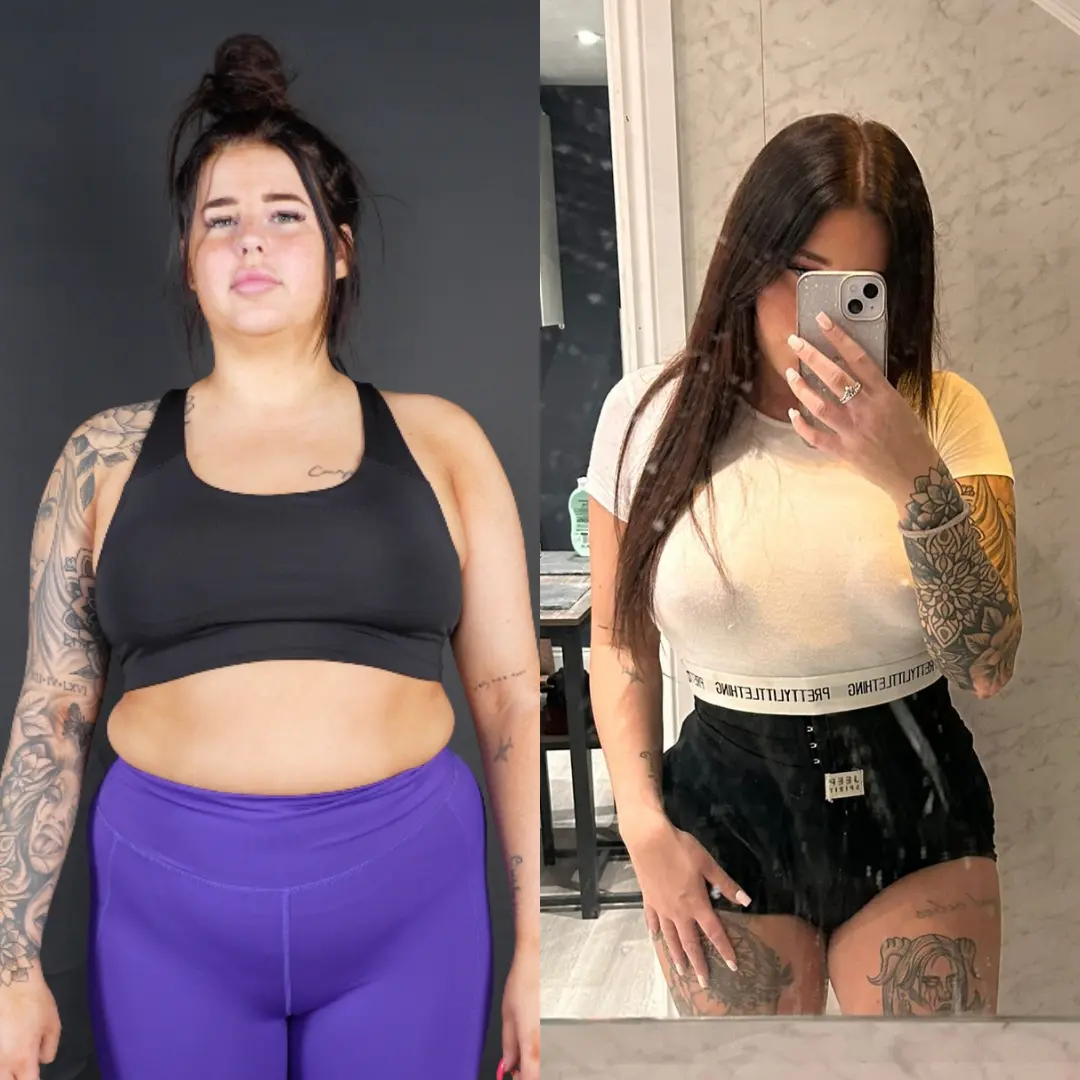 LIPOSUCTION
